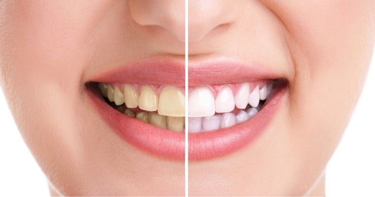 How Much Does Teeth Whitening Cost?