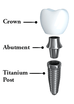 The three separated parts of the implant