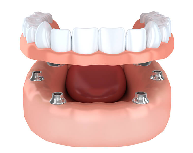 Image showing a system similar to All on four dentures