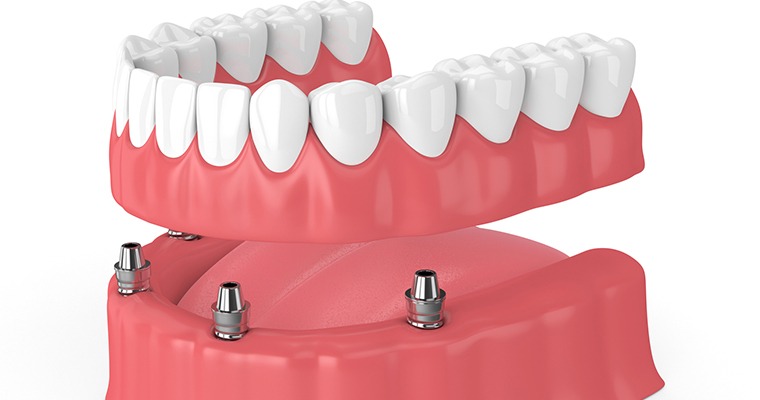 Model of implant retained dentures showing the implant posts and dentures