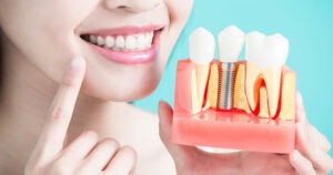 Are you a good candidate for dental implants?