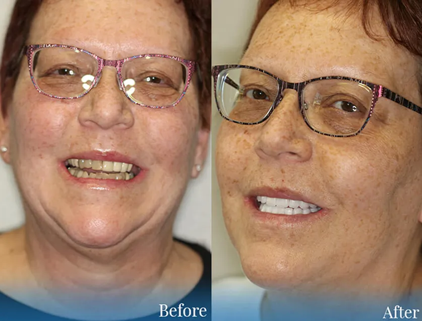 Before & After Real Patient Cosmetic Dentistry