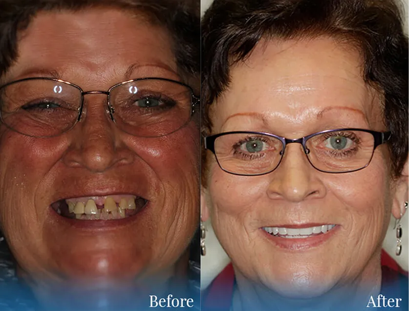 Before and after of a real patient at Aesthetic Dental Center with Smile Makeover treatment