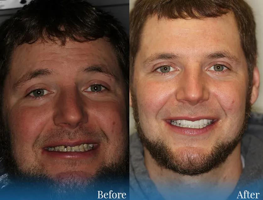 Before and after of a real patient at Aesthetic Dental Center with dental implants
