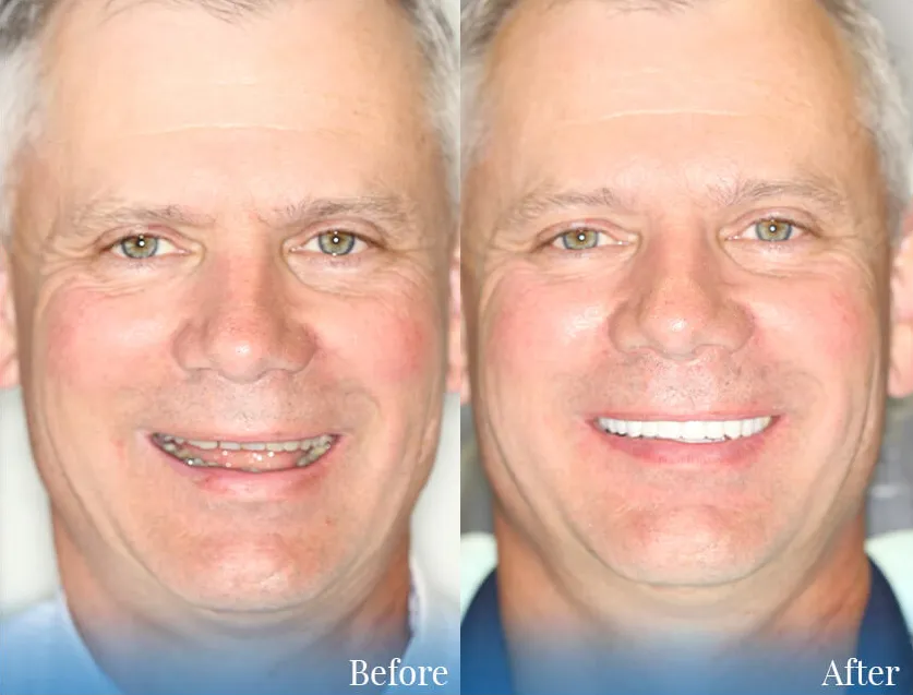 Before and after of a real patient at Aesthetic Dental Center with prosthodontics treatment