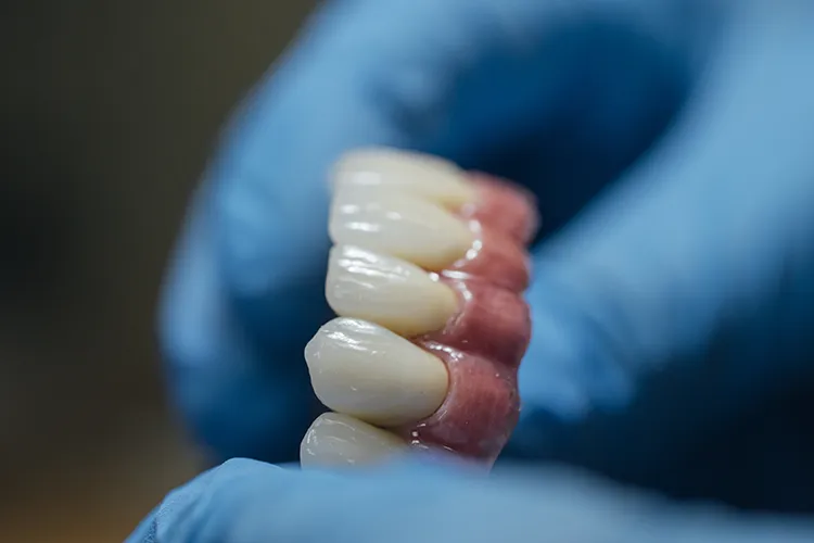 Full Arch Dental Implant Bridge