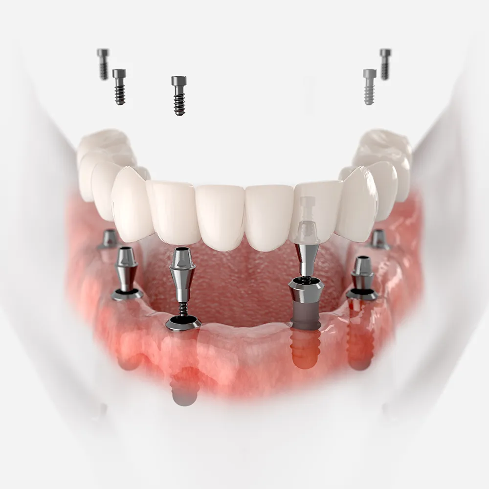 Full Mouth - All on 4 Dental Implants Illustration