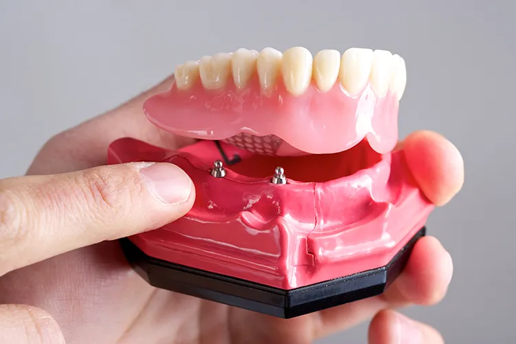 Implant Retained Denture