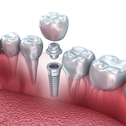 Dental Implant Illustration
