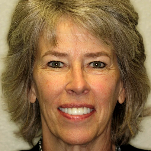 Porcelain Veneers After Patient Bismarck