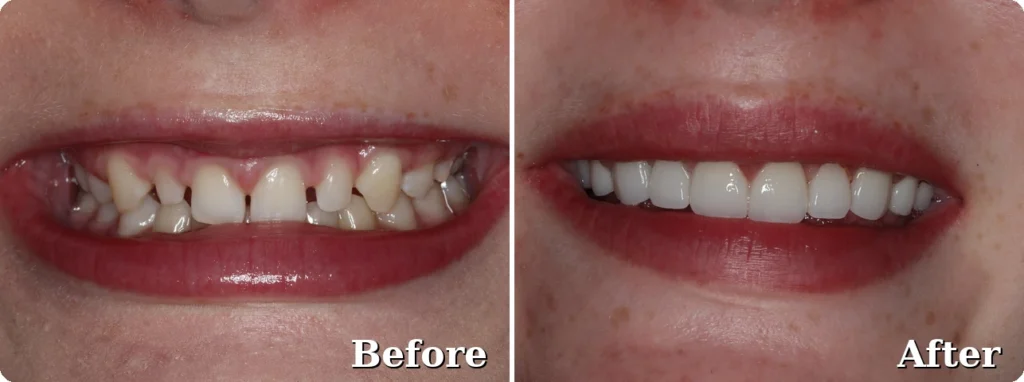 Porcelain Veneers Before & After Smile Makeover